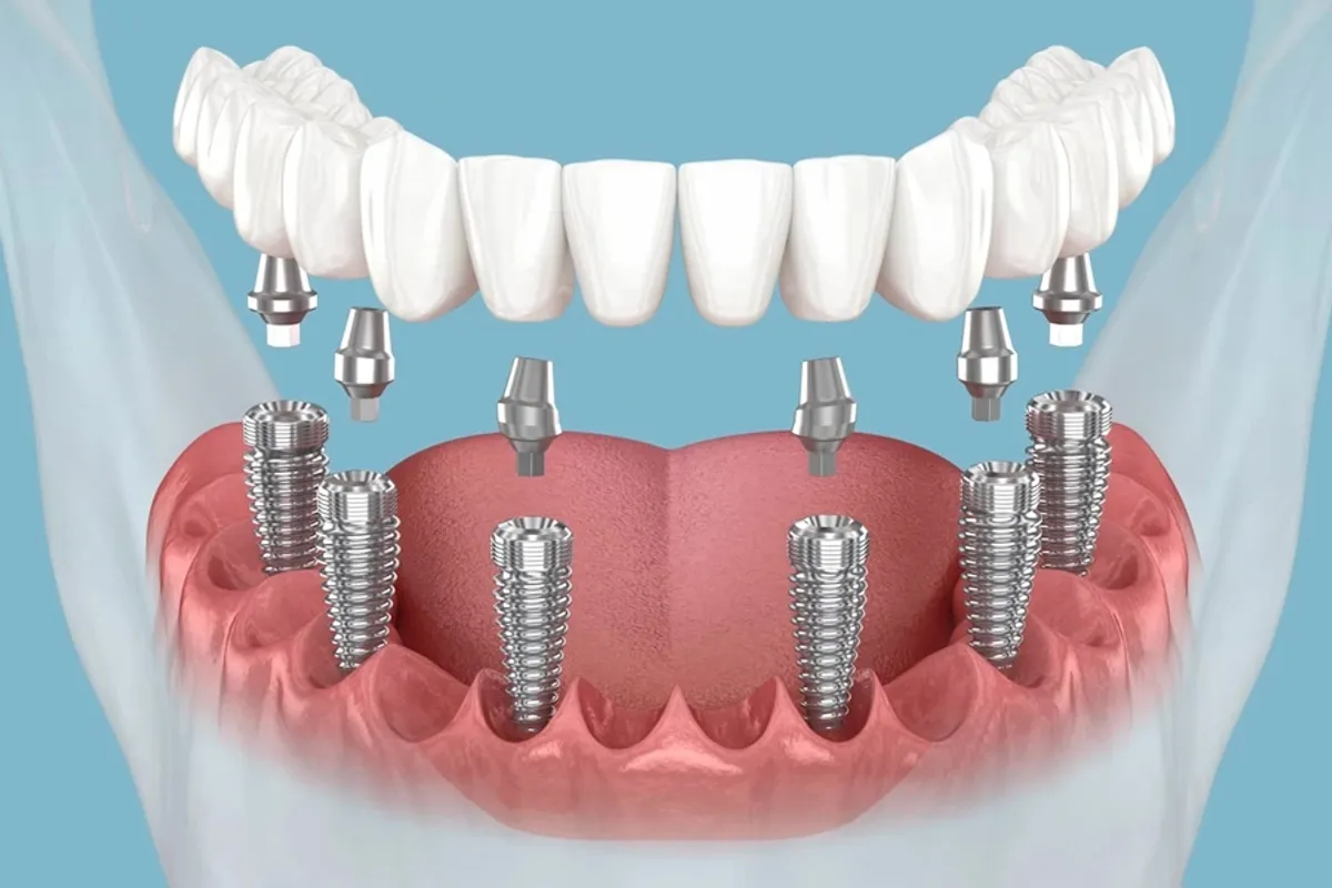 All-on-6 implant tam ağız sabit diş tedavisi Işın Dental Klinik Antalya