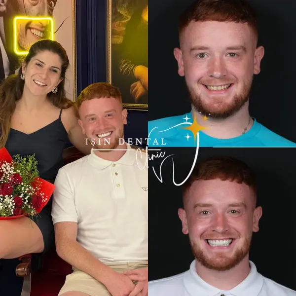 Before and After Treatment 13