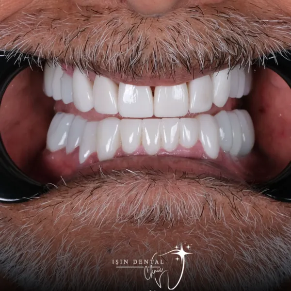 Before and After Treatment 3