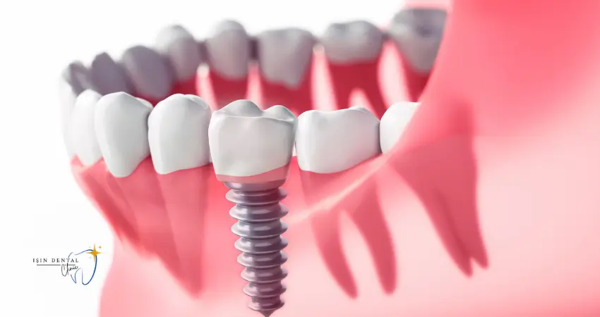 Dental implant procedure at a modern clinic in Antalya, Turkey