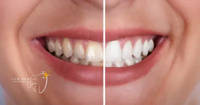 Teeth Whitening