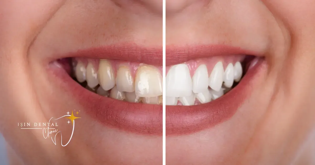 Professional teeth whitening bright smile result at Işın Dental Clinic Antalya Turkey