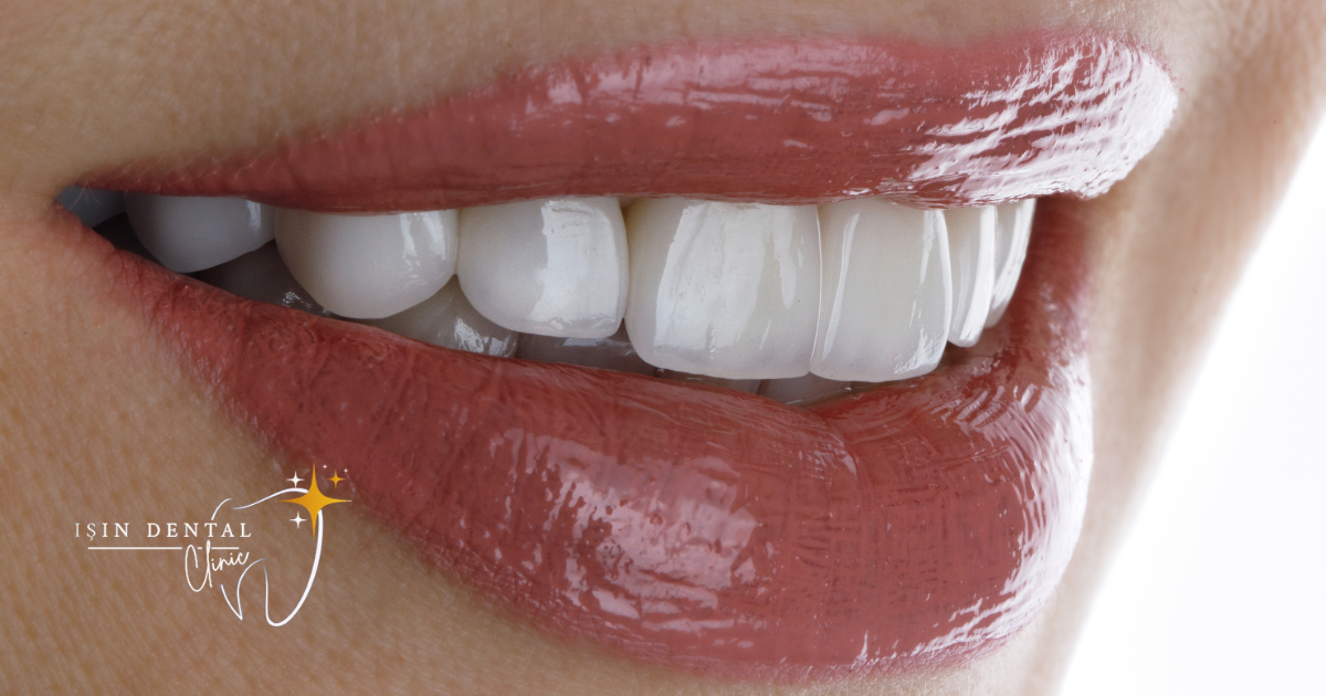 Veneers versus crowns comparison, E-max and zirconium options at Işın Dental Clinic Antalya
