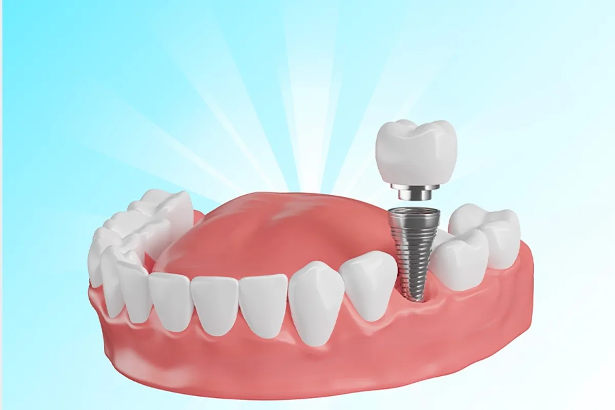 Zygomatic Implants