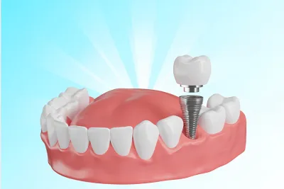 Zygomatic Implants
