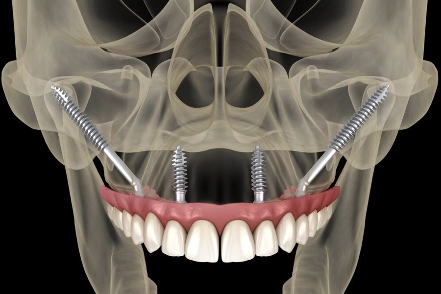 Zygomatic Implants