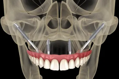 Zygomatic Implants