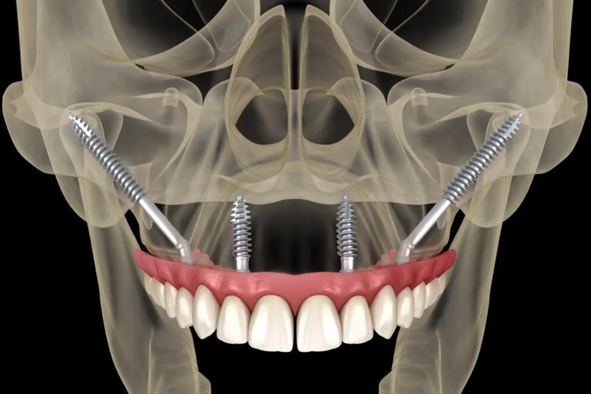 Zygomatic implant surgery for severe bone loss patients at Işın Dental Clinic Antalya