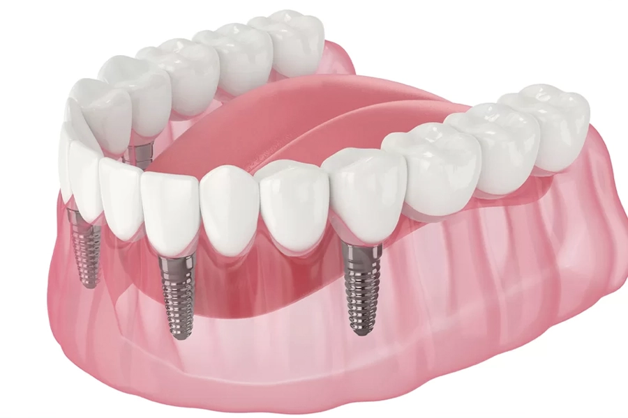All-on-4 dental implants restoring a full arch on four implants at Işın Dental Clinic Antalya