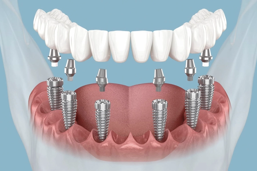 All-on-6 dental implants restoring a full arch on six implants at Işın Dental Clinic Antalya