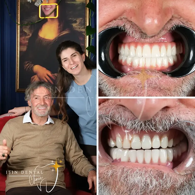 Diş tedavisi öncesi ve sonrası - Işın Dental Klinik