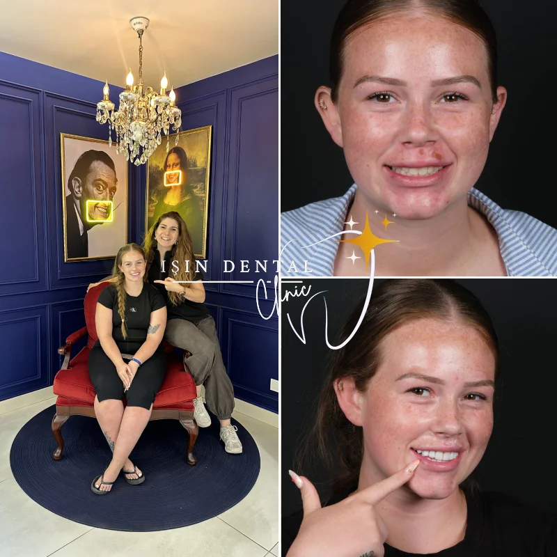 Diş tedavisi öncesi ve sonrası - Işın Dental Klinik