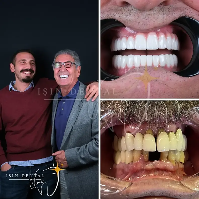Zirkonyum kaplama öncesi ve sonrası - Işın Dental Klinik