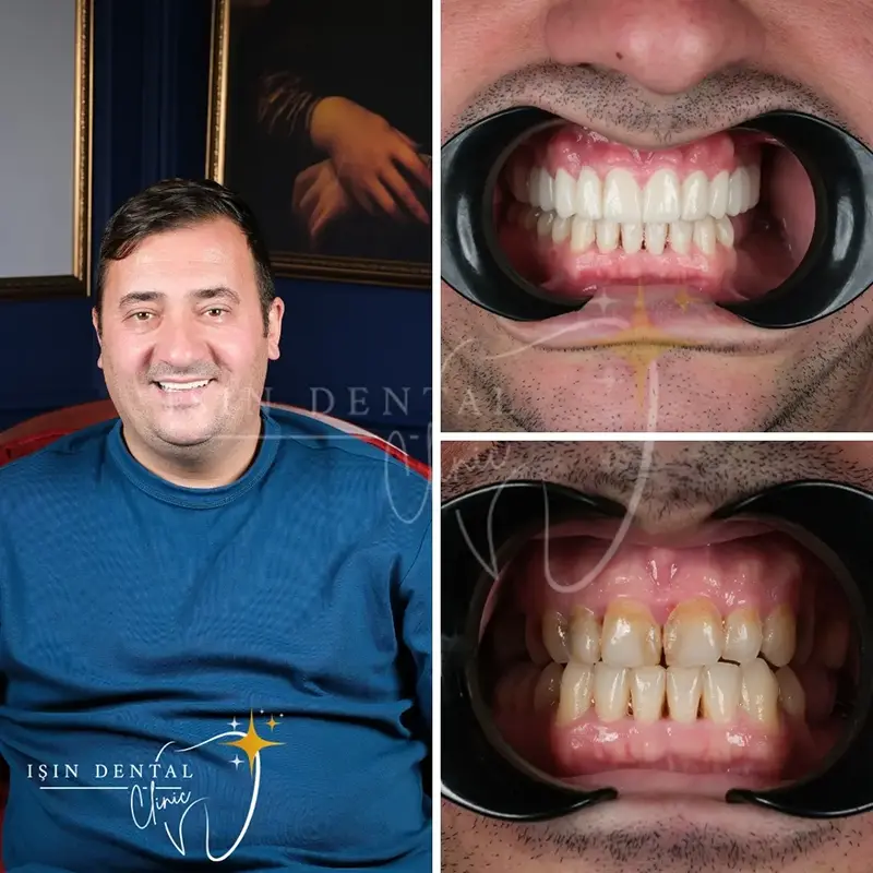 İmplant tedavisi öncesi ve sonrası - Işın Dental Klinik