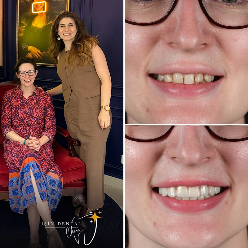 Dental treatment before and after - Isin Dental Clinic