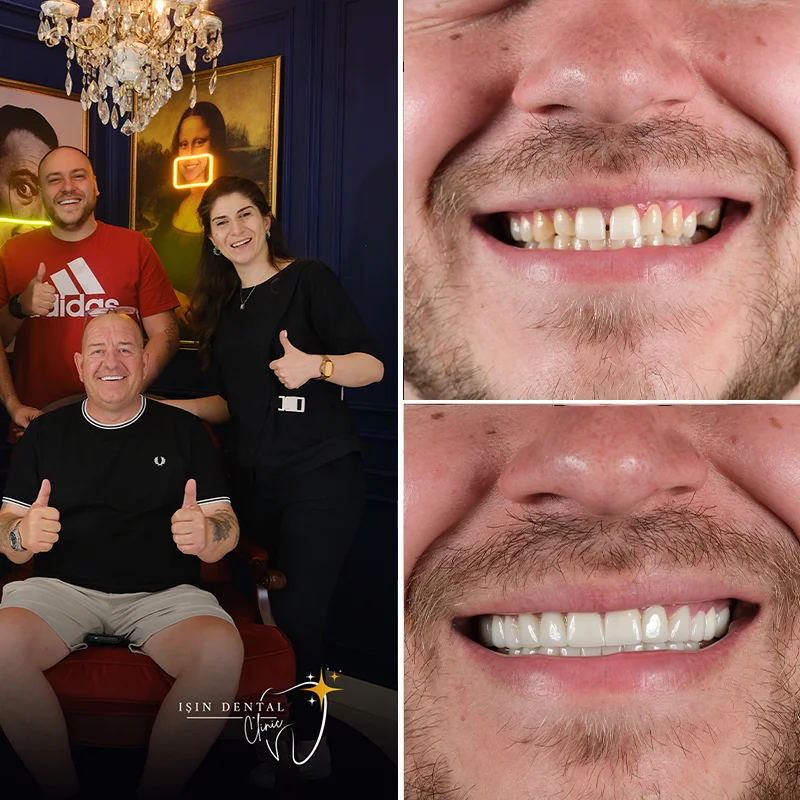 Dental treatment before and after - Isin Dental Clinic