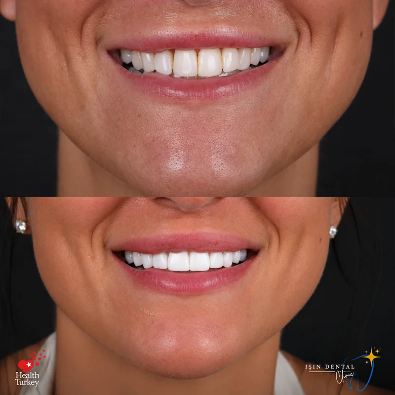 Dental treatment before and after - Isin Dental Clinic