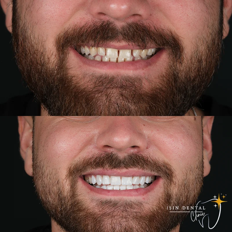 Dental treatment before and after - Isin Dental Clinic